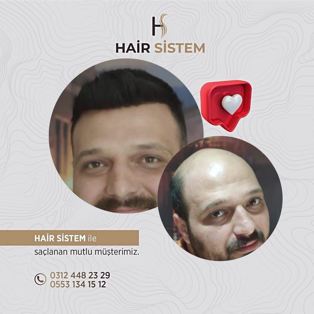 Hair Sistem