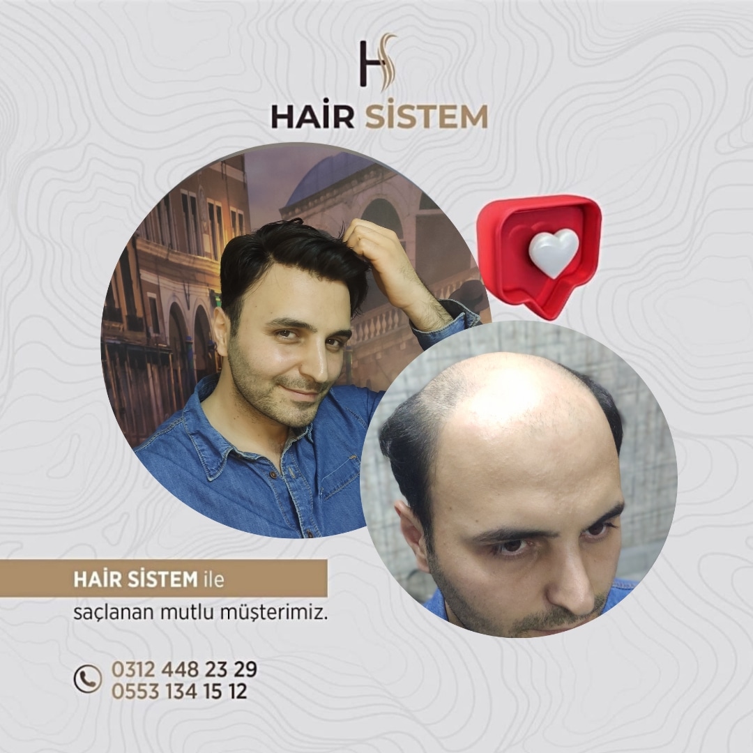 Hair Sistem