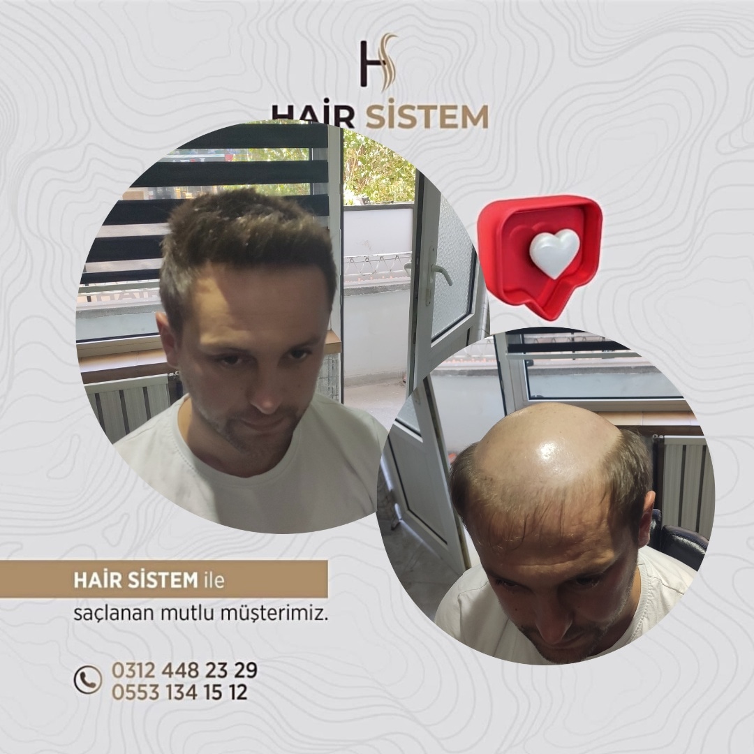 Hair Sistem