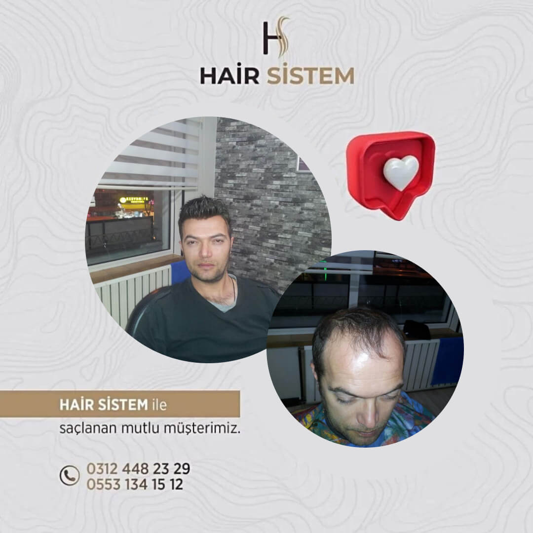 Hair Sistem