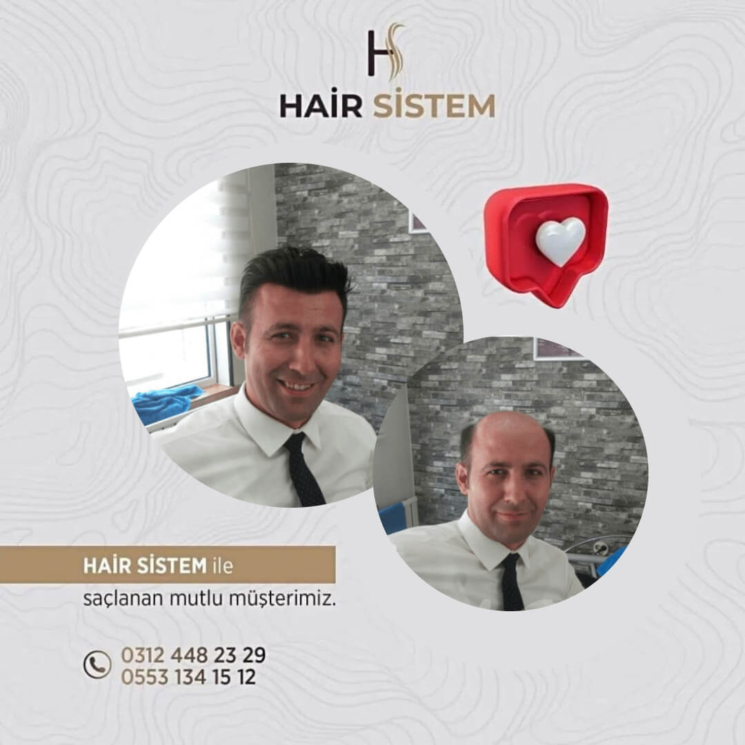 Hair Sistem