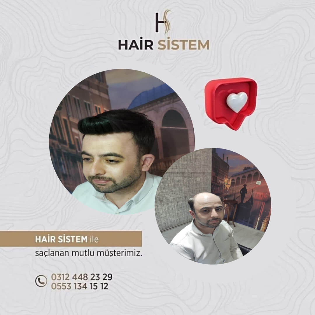Hair Sistem