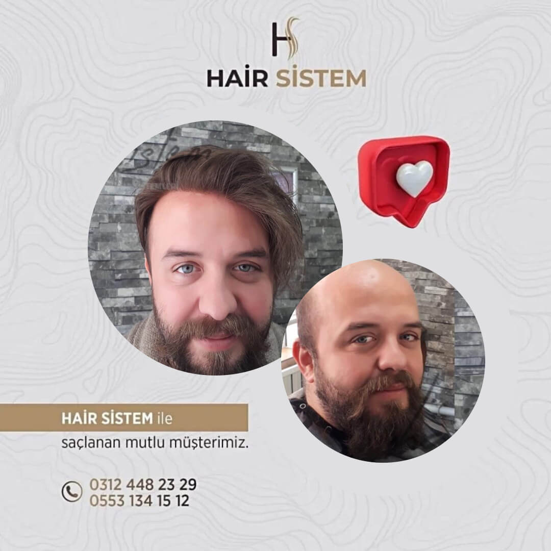 Hair Sistem
