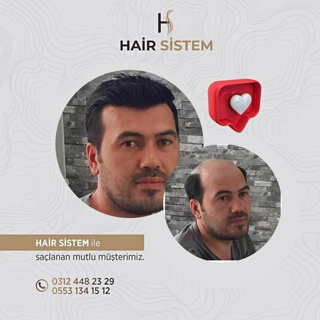 Hair Sistem