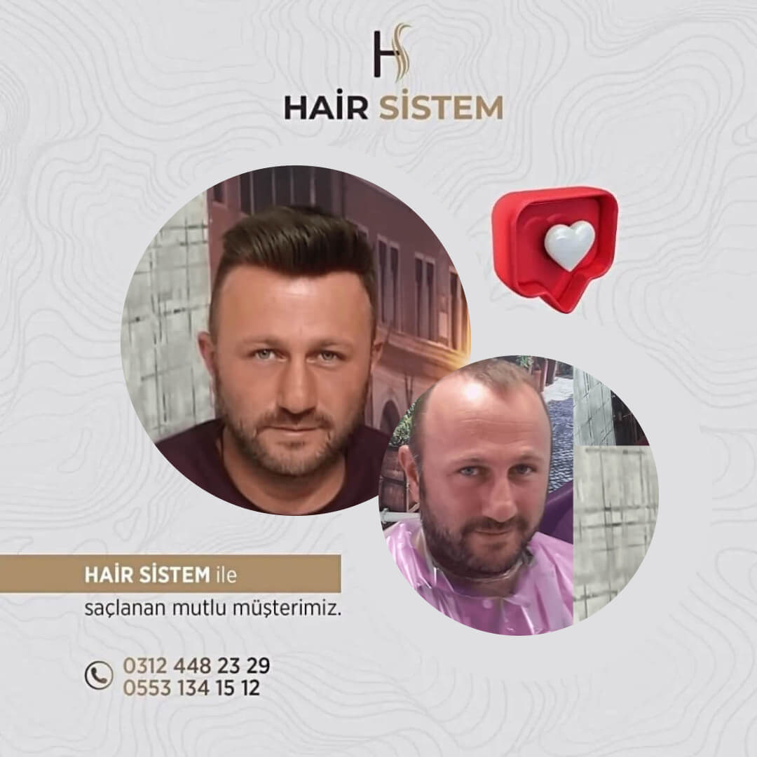 Hair Sistem