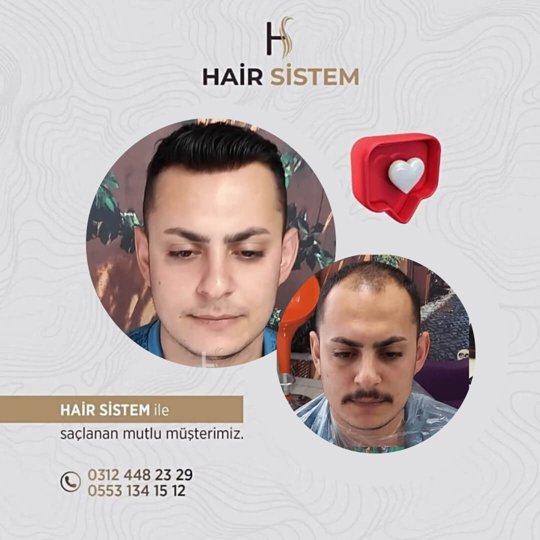 Hair Sistem