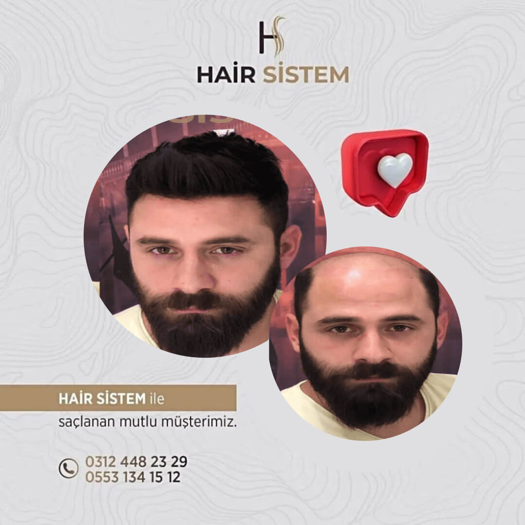Hair Sistem