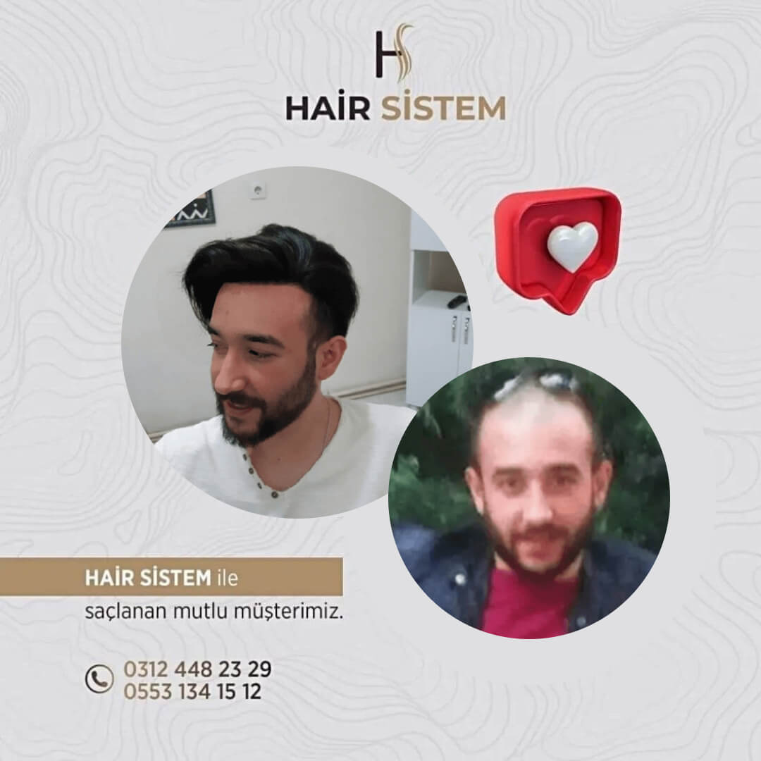 Hair Sistem