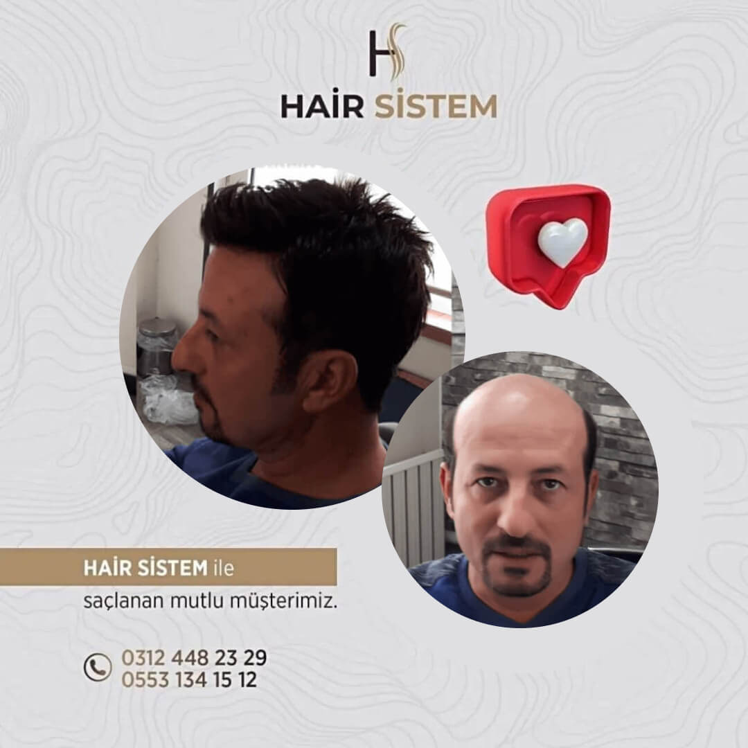 Hair Sistem